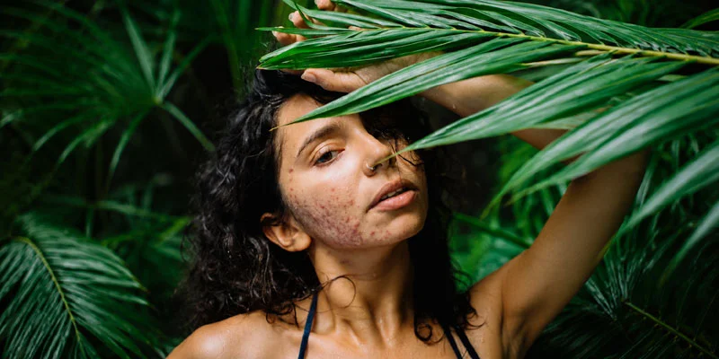 Common Rainy Season Skin Problems and Simple Fixes